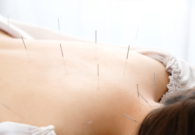 鍼灸